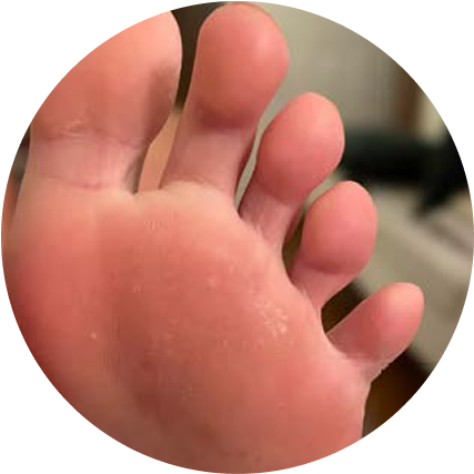 Close-up of a foot with a bit of discoloration on the skin