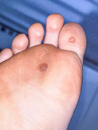 Close-up of a foot with a visible wart on a blue background