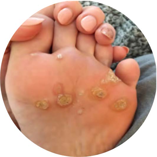 Close-up of a foot with multiple warts and fungi growing on the bottom