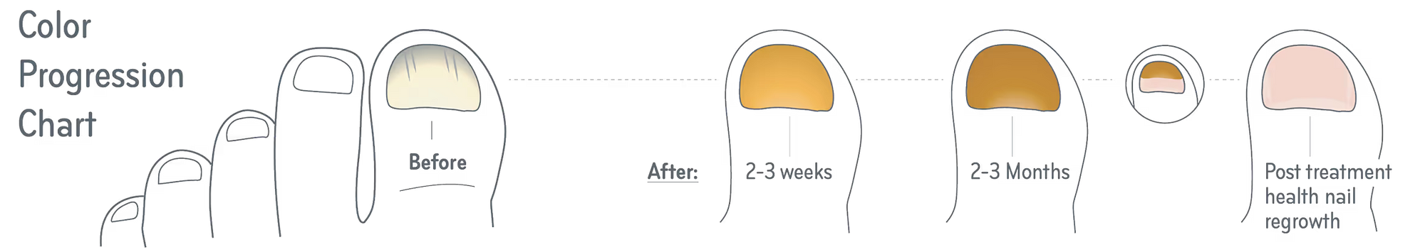 Color Progression Chart of the toe nail before and after treatment