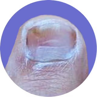 Close-up of a fingernail with a purple circular border