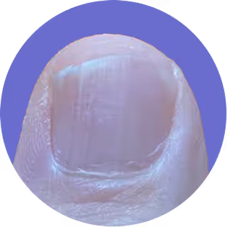 Close-up of a fingernail with a purple circular border